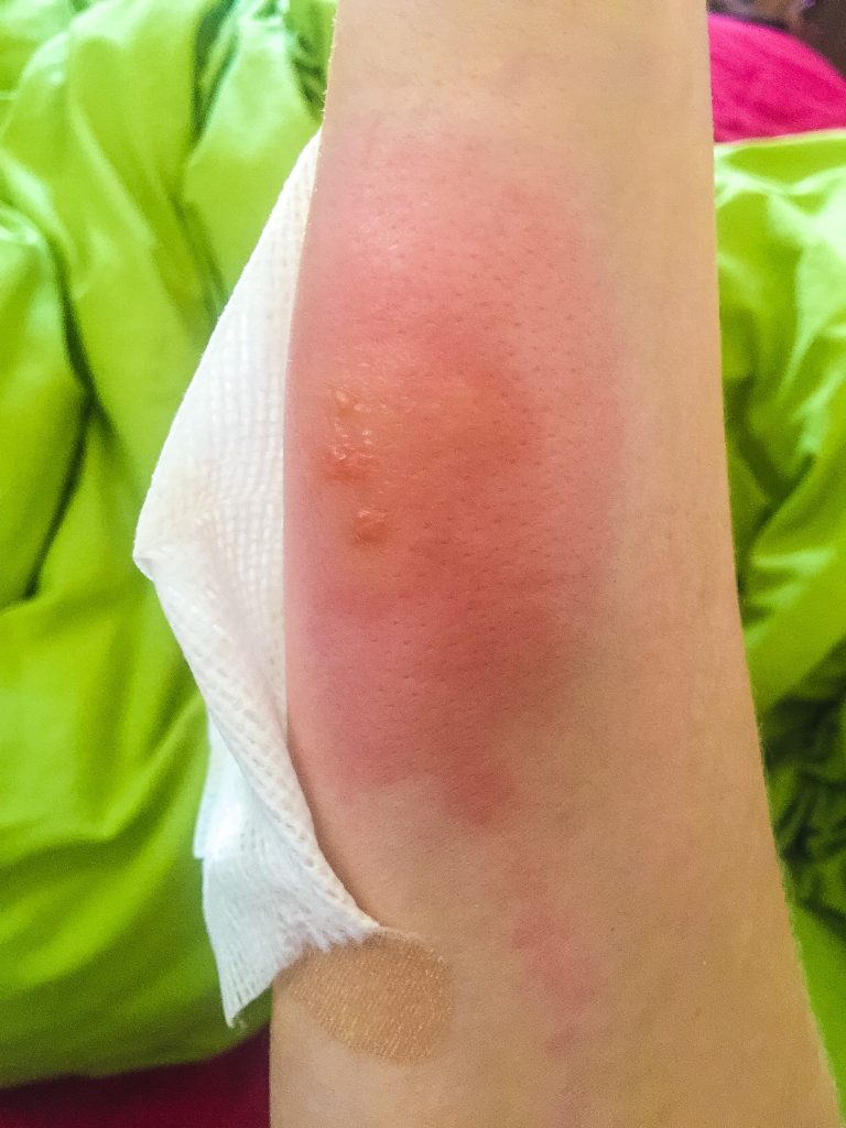 Epic spider bite - I Went to Morocco and No, I Did Not Love it